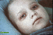 Child Very Ill with Chernobyl Radiation